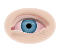 Лечение аллергии на глазах